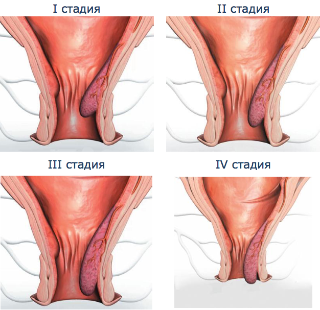 Лечение геморроя тамбове